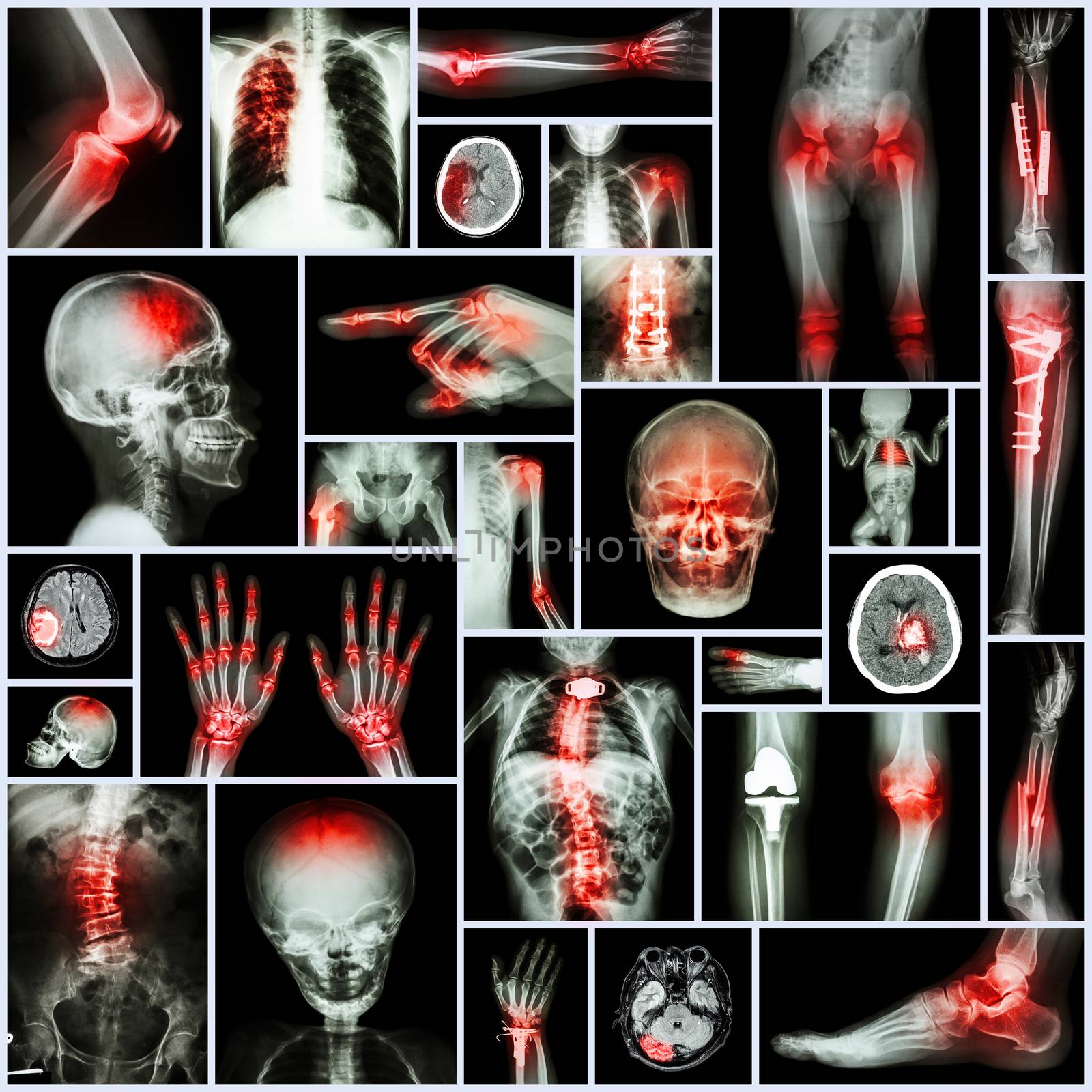Collection X-ray part of human,Orthopedic operation,Multiple disease (Fracture,Gout,Rheumatoid arthritis,Osteoarthritis knee,Stroke,Brain tumor,Scoliosis,Tuberculosis, etc.) by stockdevil