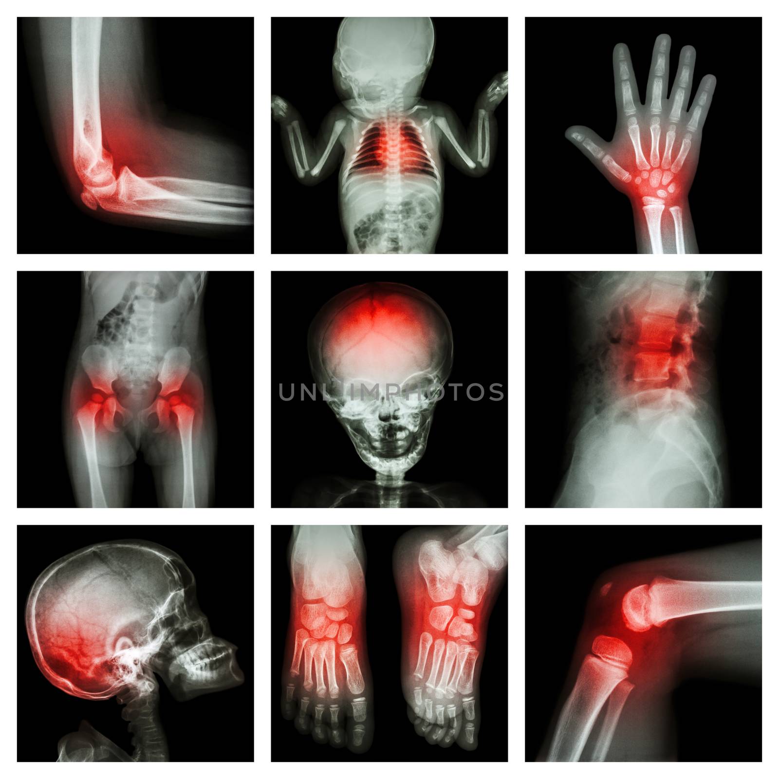 Collection X-ray part of child and multiple injury by stockdevil