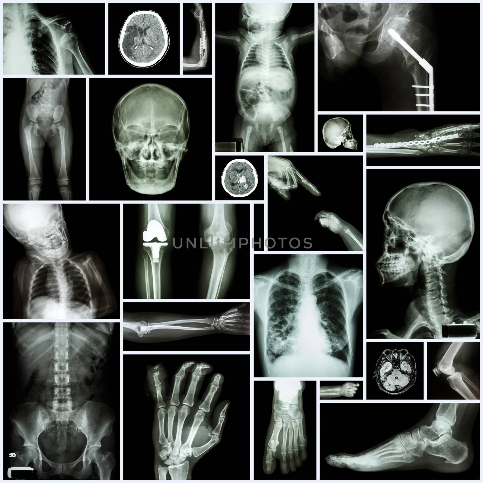 Collection X-ray "Multiple part of human" ,"Orthopedic surgery" and "Multiple disease" (Fracture,Shoulder dislocation,Osteoarthritis knee,Bronchiectasis,Lung disease,Stroke,Brain tumor, etc) by stockdevil