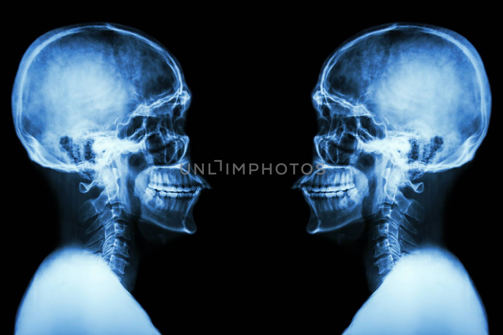 X-ray Skull and cervical spine