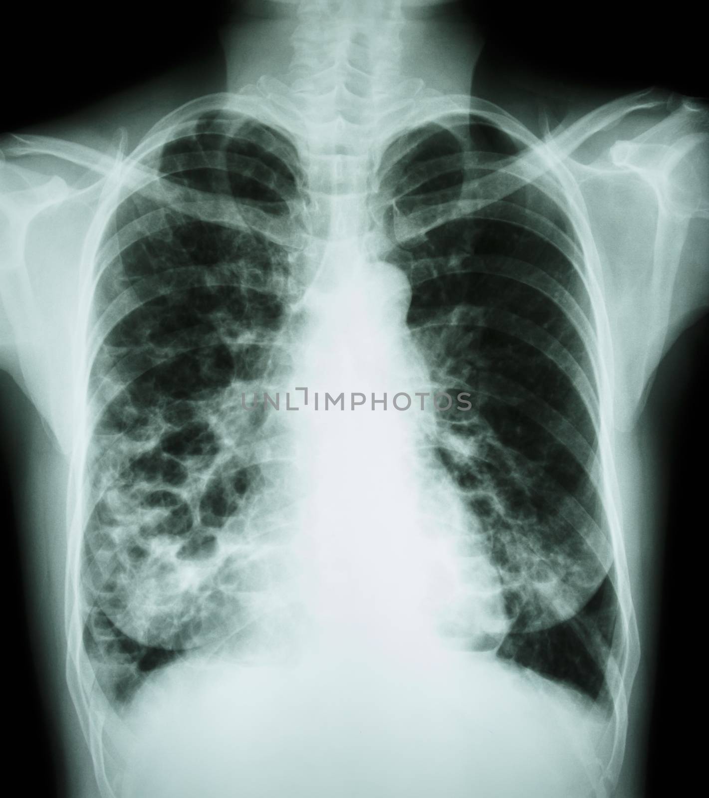 "Bronchiectasis" X-ray chest show : multiple lung bleb and cyst due to chronic infection