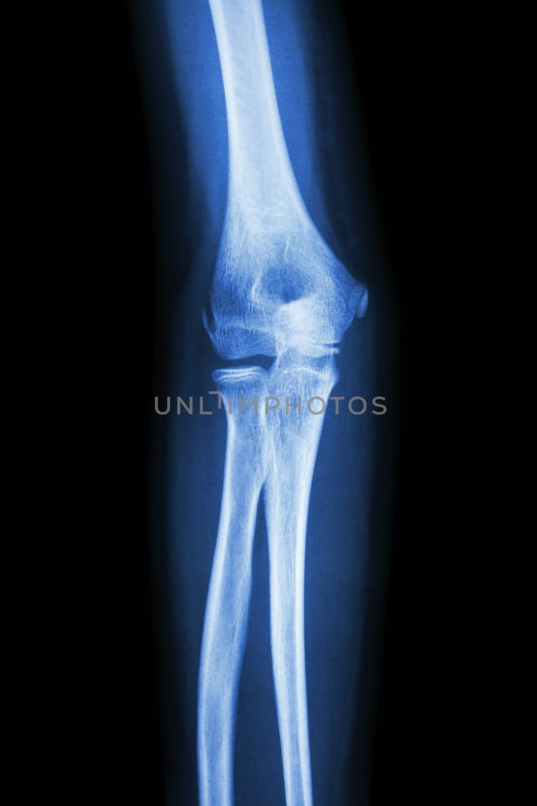 film x-ray elbow AP : show normal human's elbow