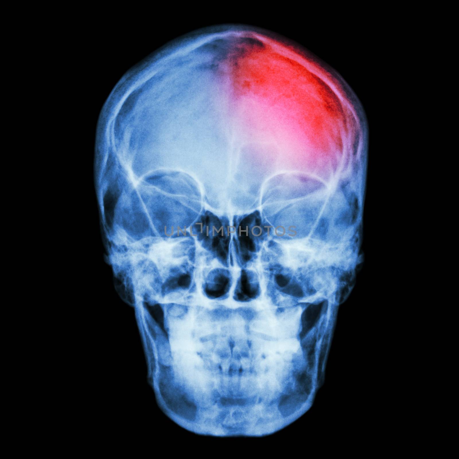 Film X-ray skull and headache. (Stroke,Cerebrovascular accident) by stockdevil