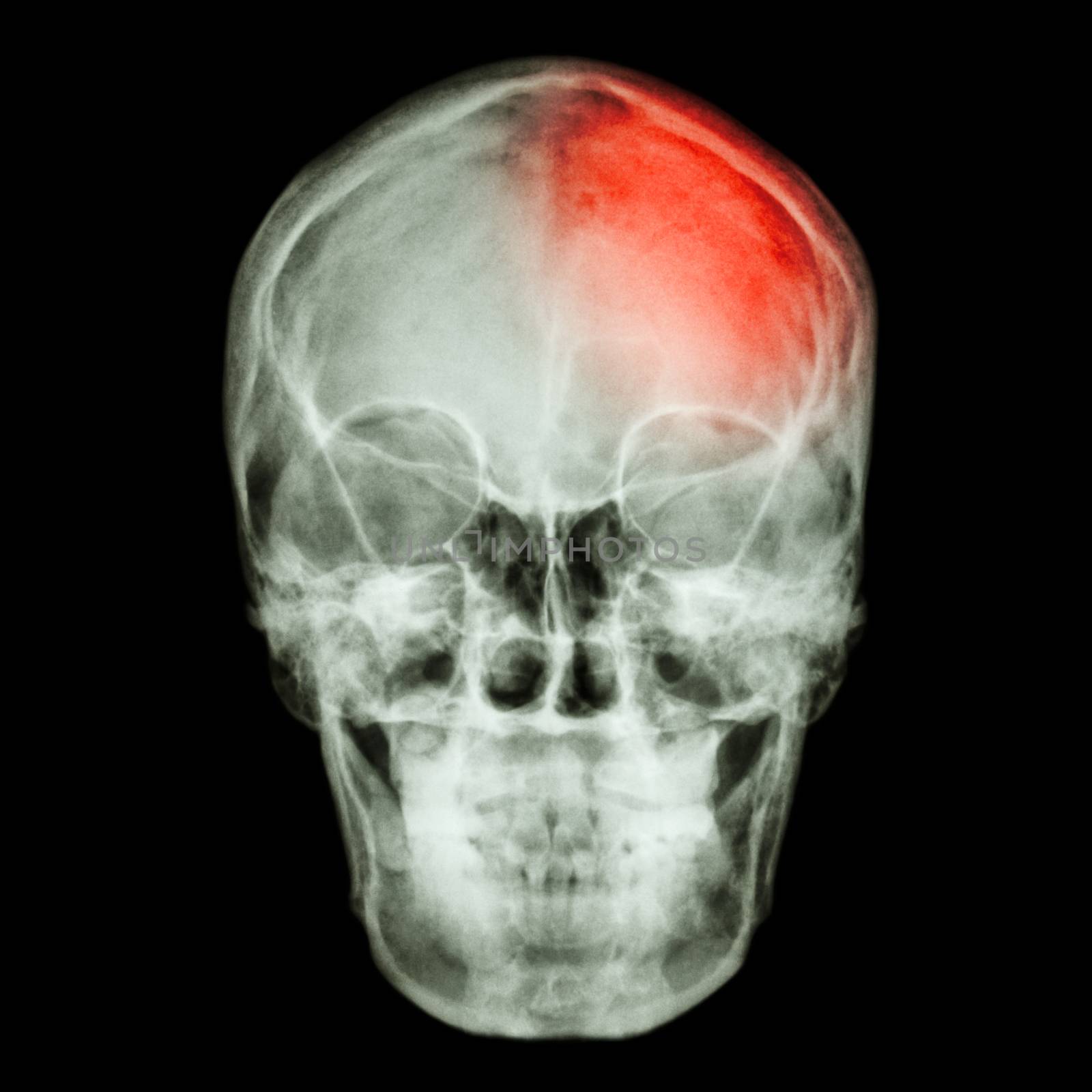 Film X-ray skull and headache. (Stroke,Cerebrovascular accident) by stockdevil