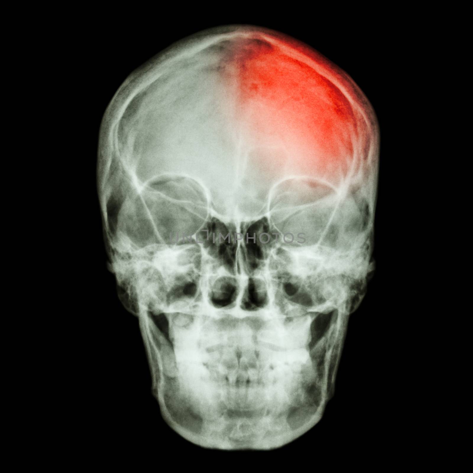 Film X-ray skull and headache. (Stroke,Cerebrovascular accident)