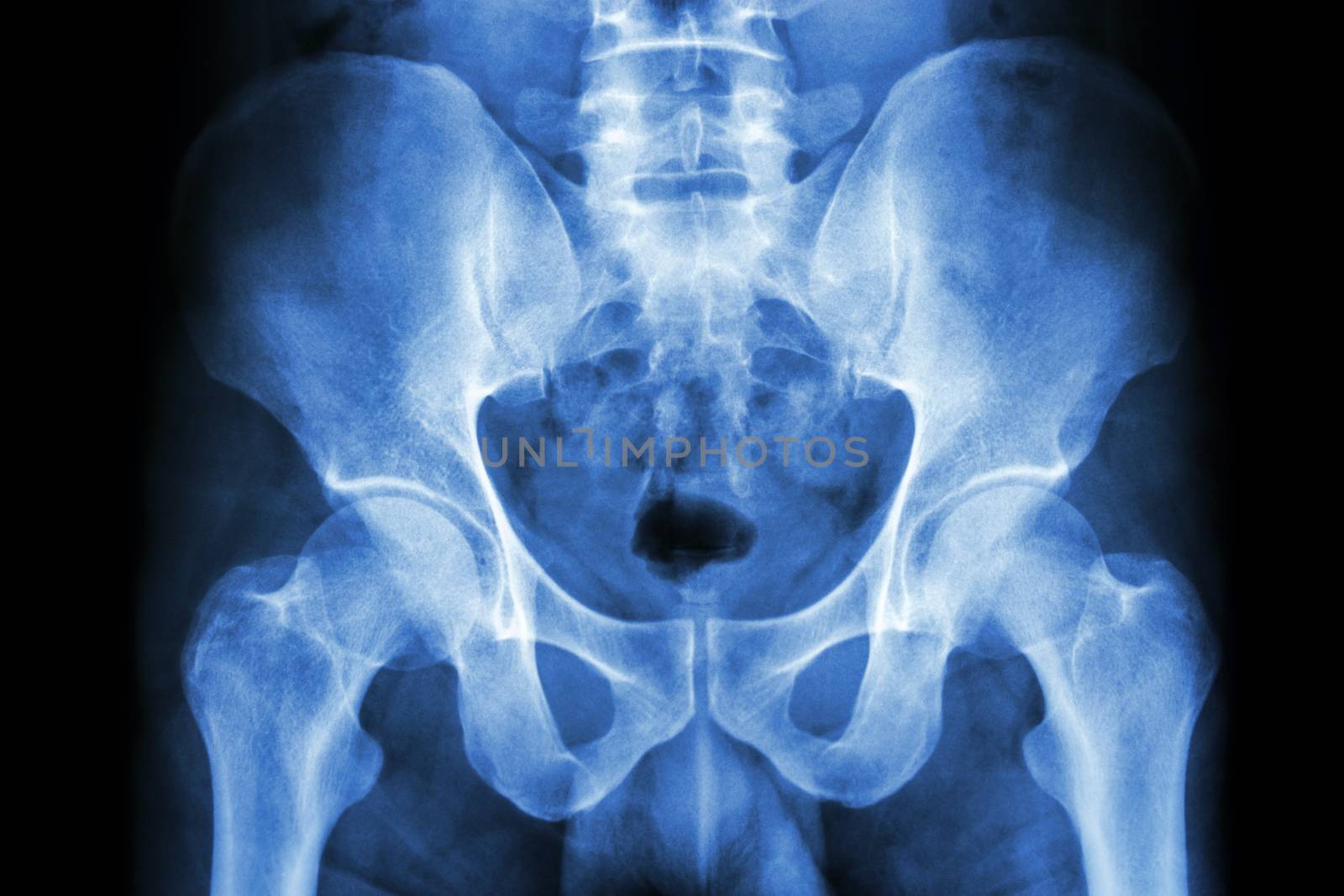 film x-ray human's pelvis and hip joints