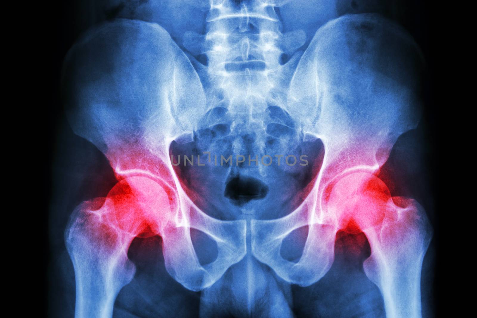 film x-ray human's pelvis and arthritis at both hip joint (Gout , Rheumatoid)