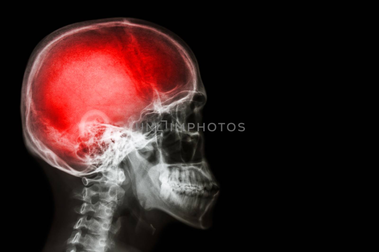 X-ray skull & cervical spine (lateral) with "Stroke"