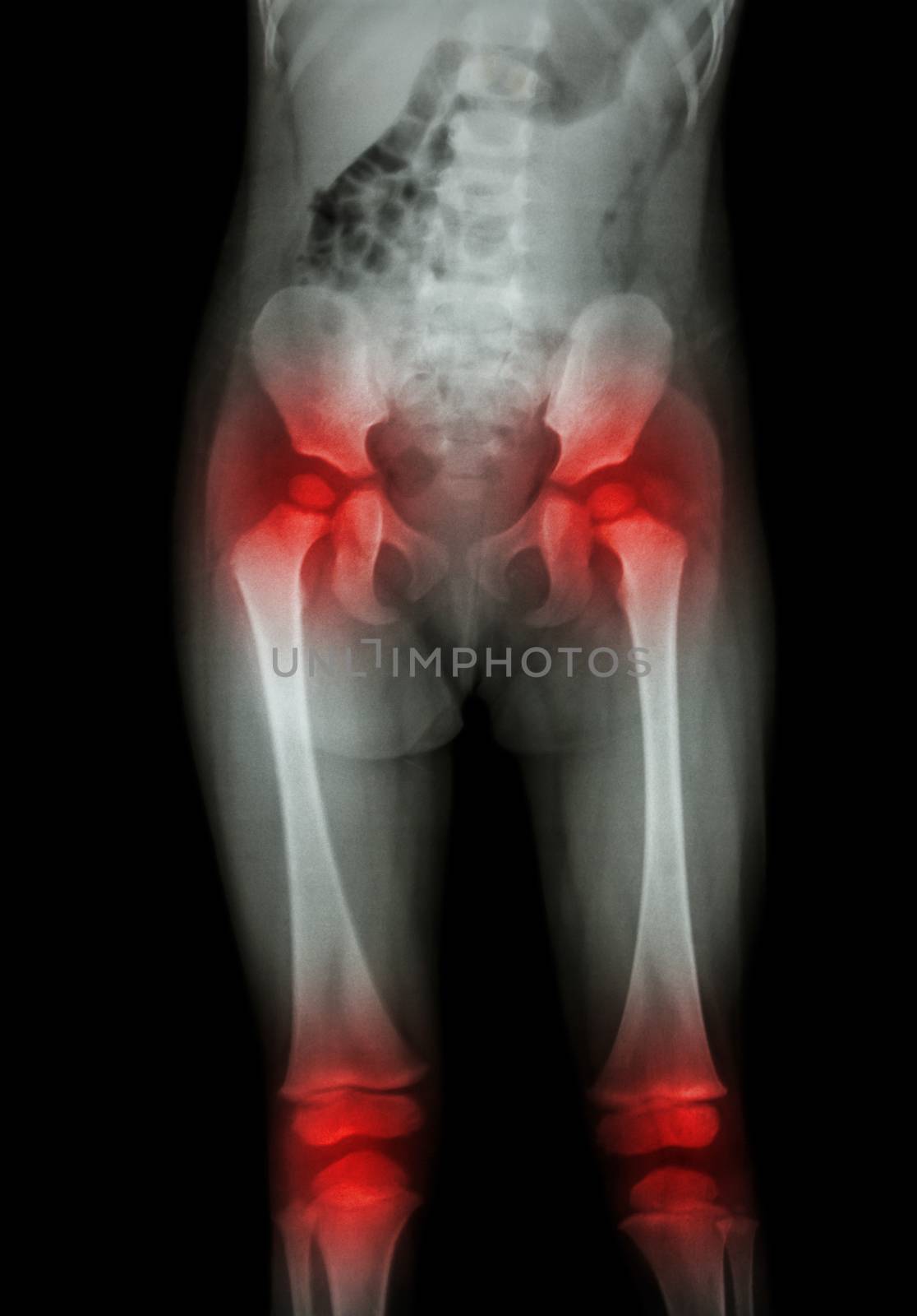 Film x-ray body of child (abdomen,buttock,thigh,knee) and arthritis at both hip , both knee (Gout,Rheumatoid)