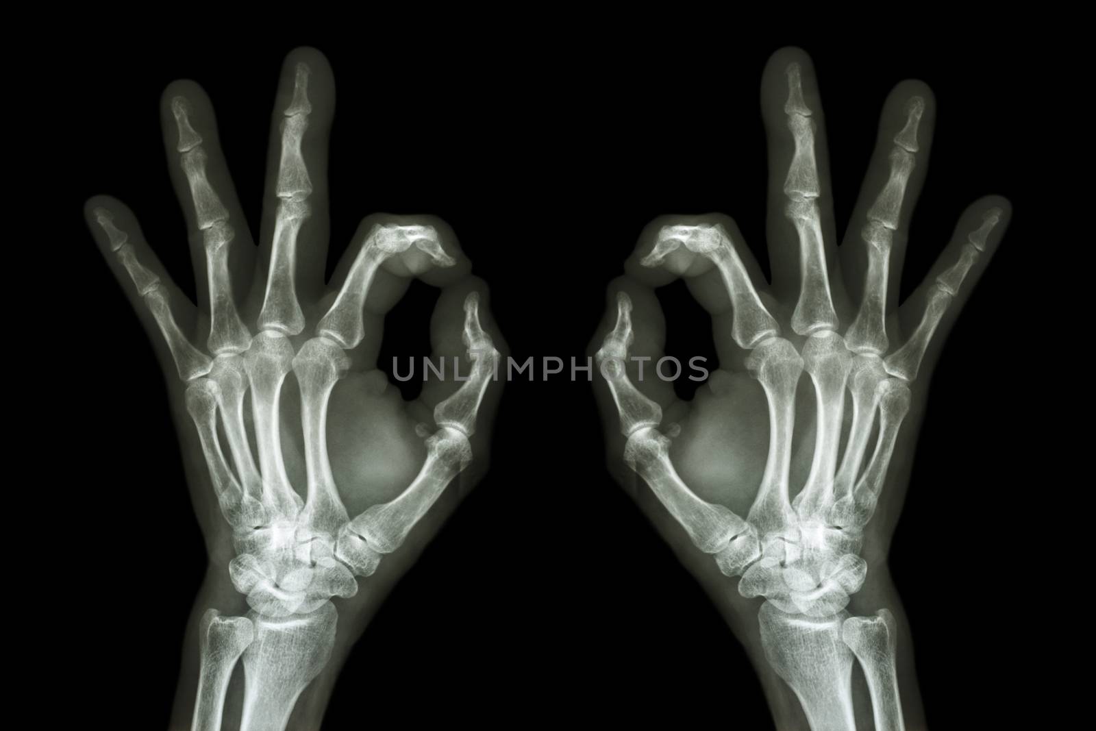 X-ray hands with OK sign