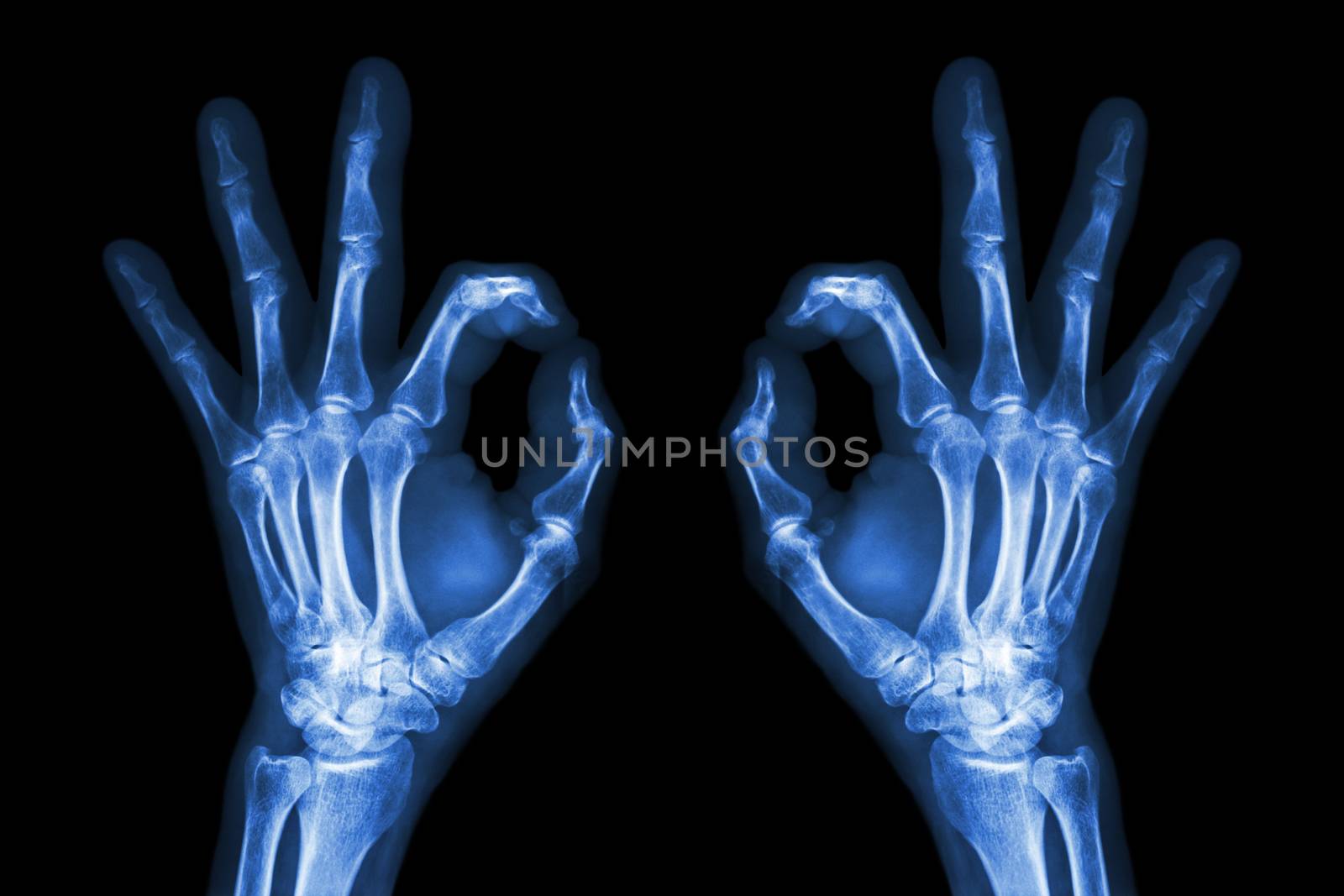 X-ray hands with OK sign