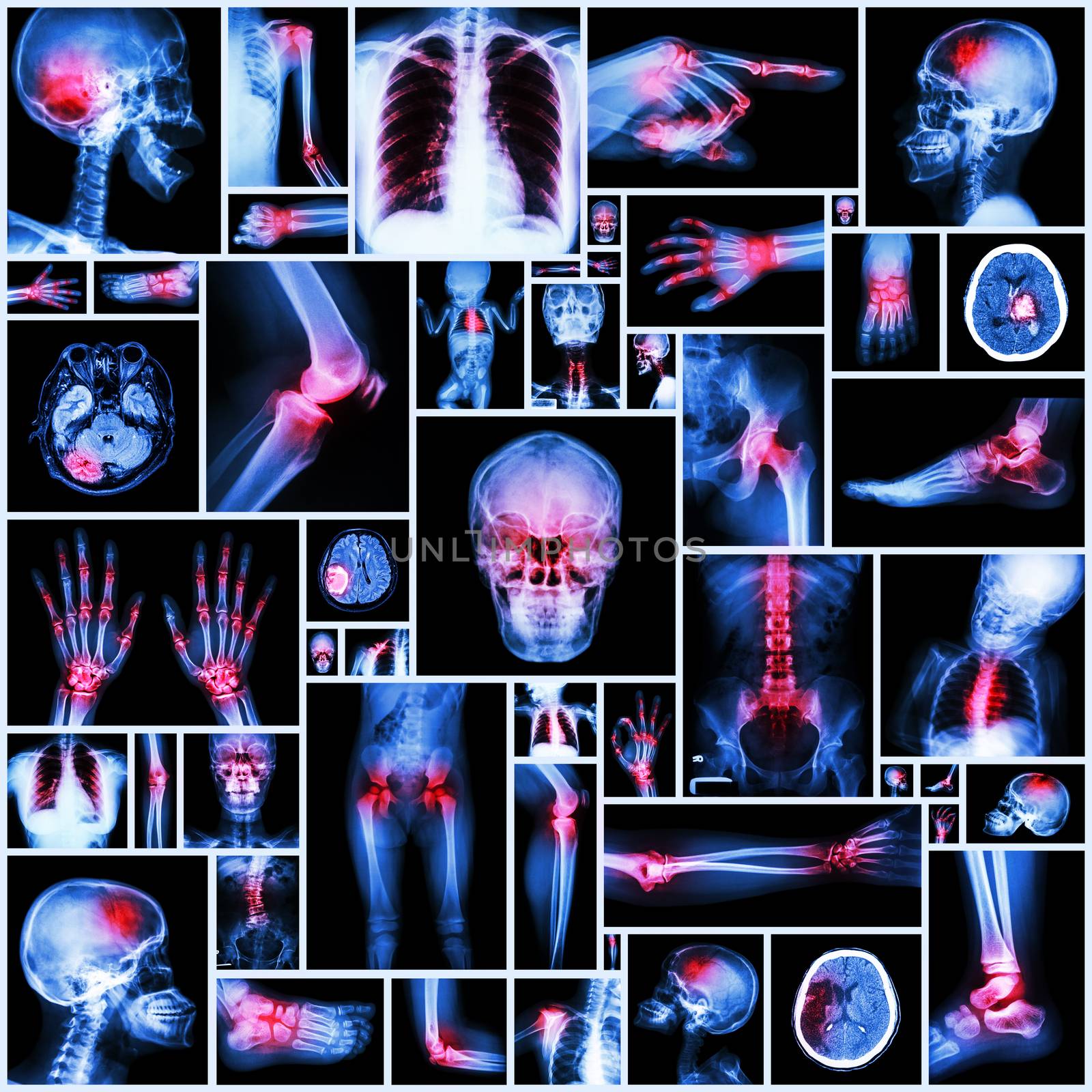 Collection X-ray multiple organ and arthritis at multiple joint (Rheumatoid,Gout) by stockdevil
