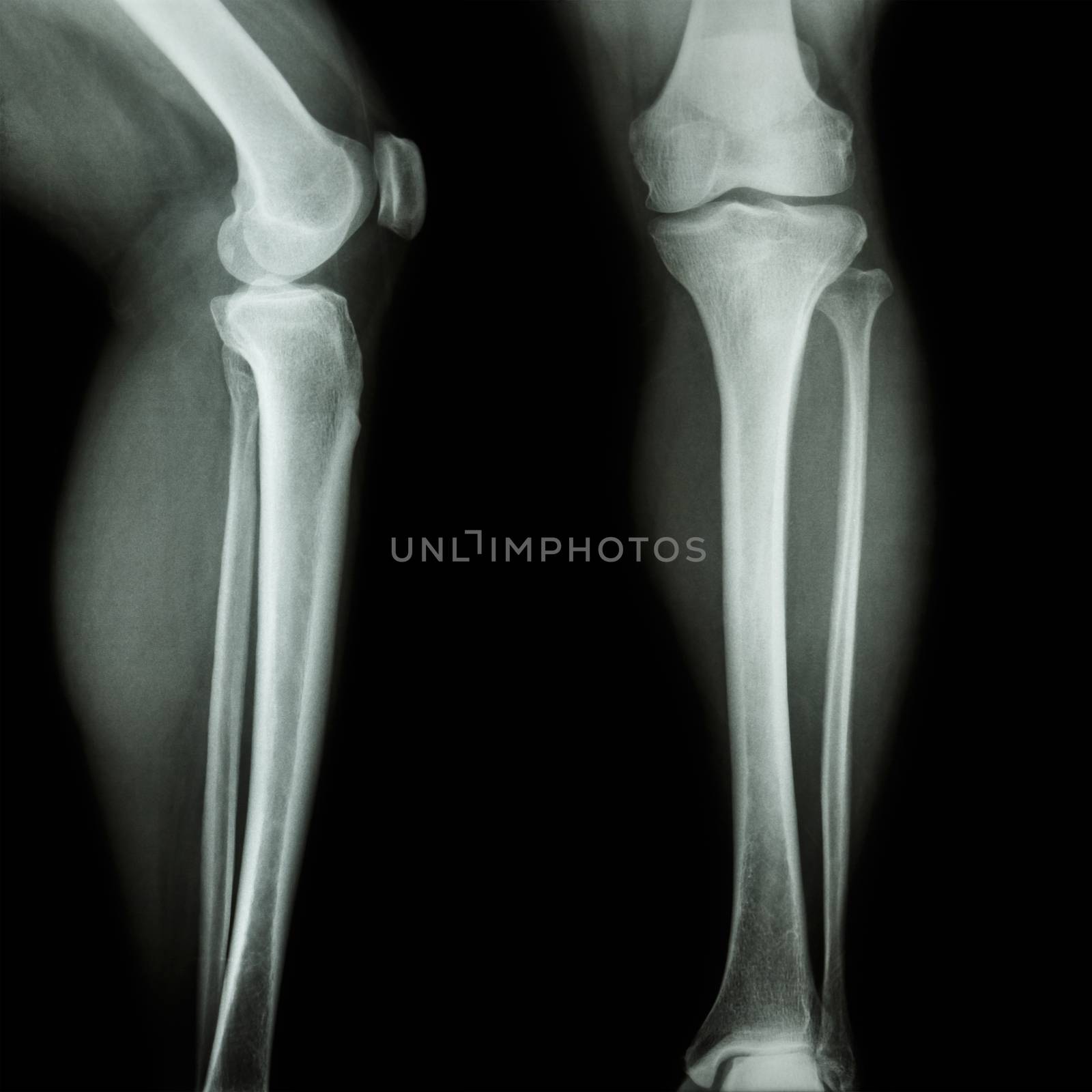 film x-ray leg & knee AP(Anterior-Posterior)/lateral by stockdevil