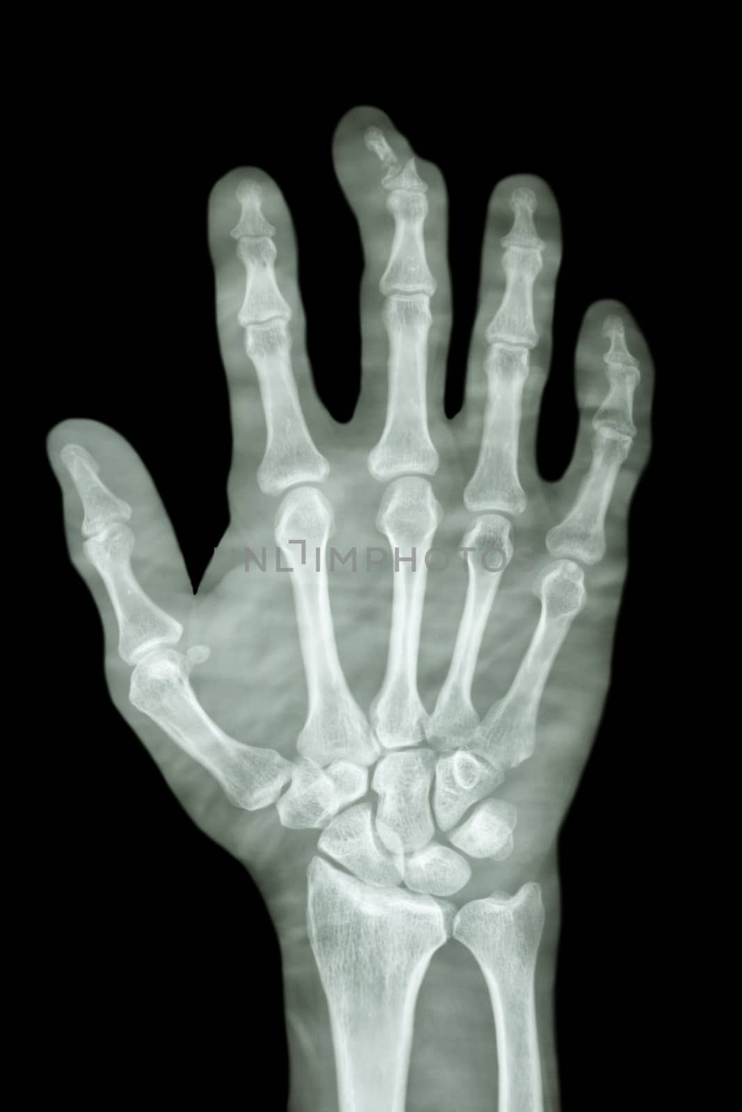 comminute fracture distal pharange of middle finger