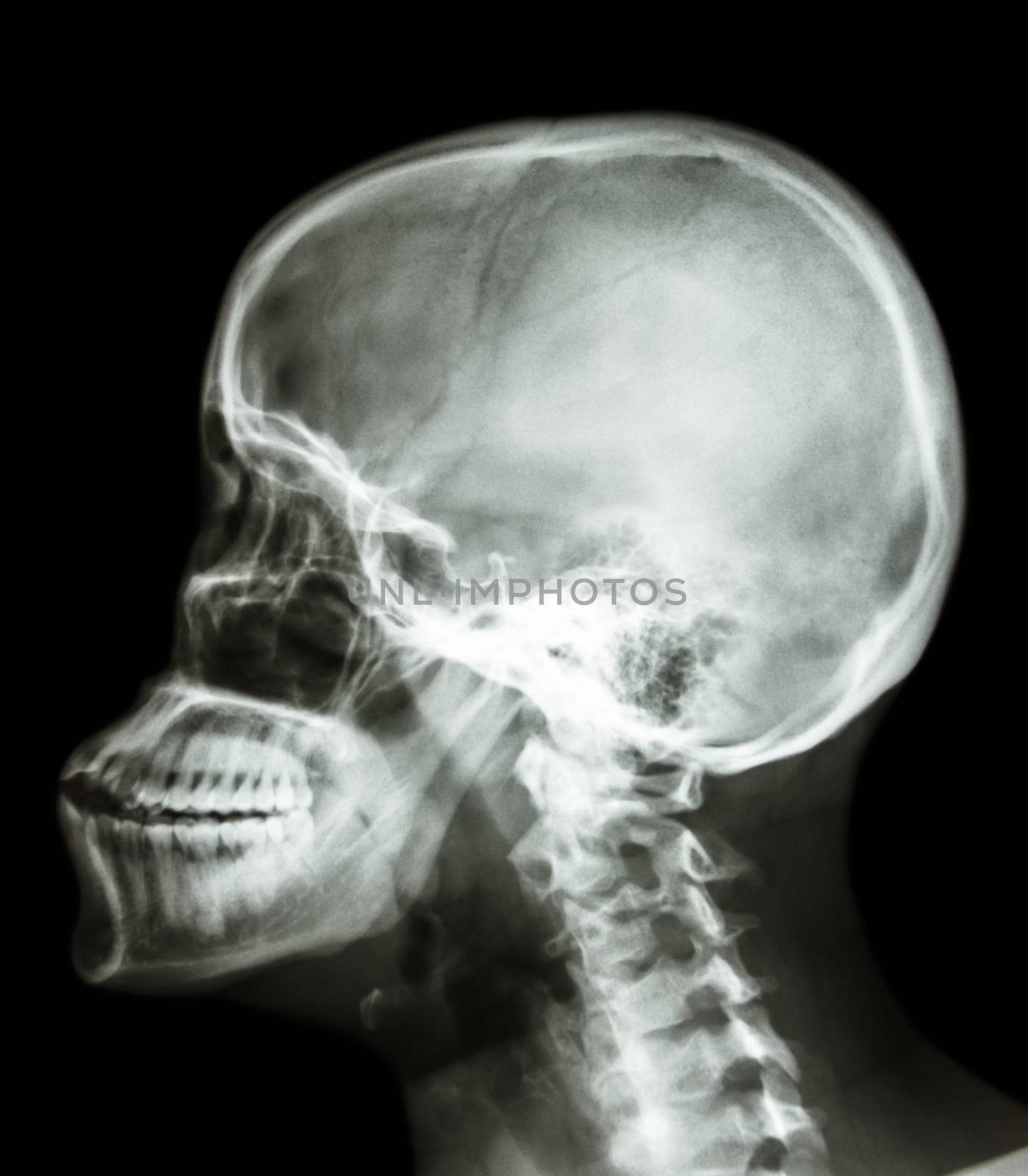 film x-ray skull lateral : show human's skull and cervical spine