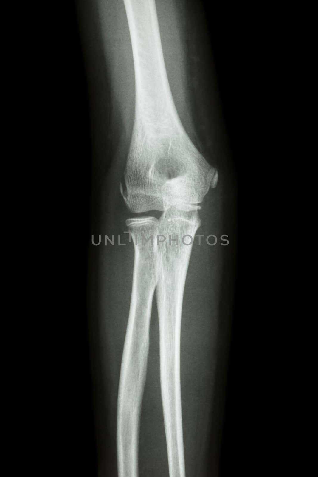 film x-ray elbow AP : show normal human's elbow