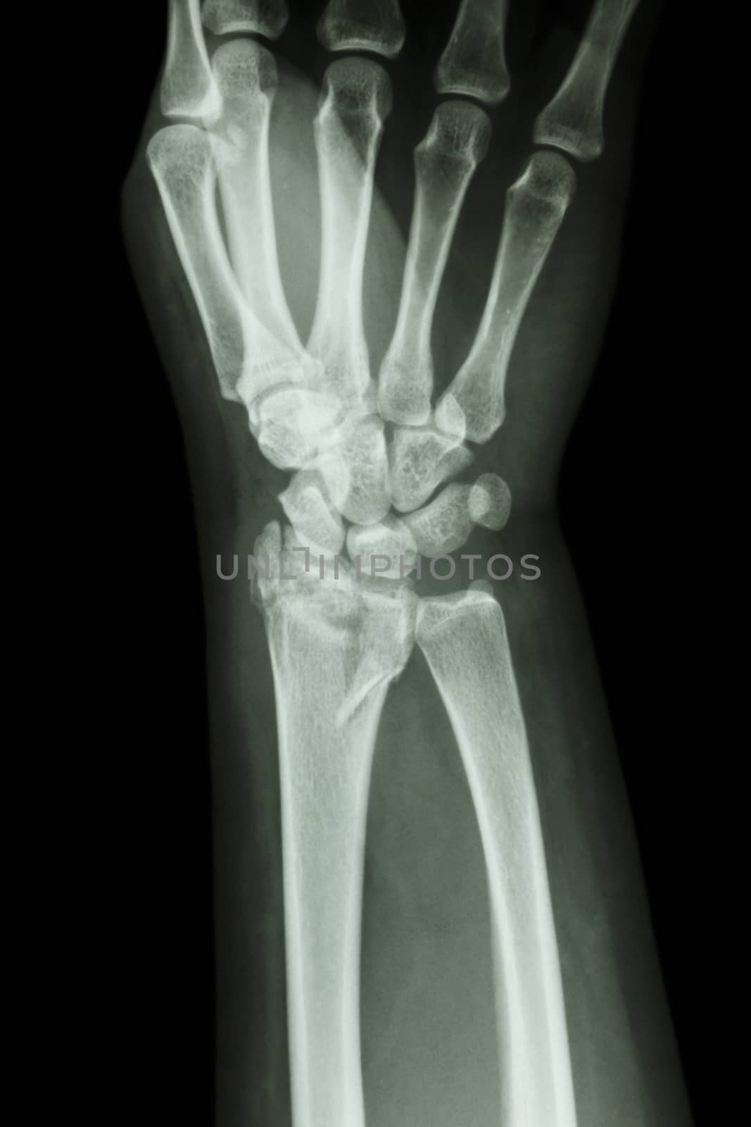 fiilm x-ray wrist show fracture distal radius (forearm's bone)