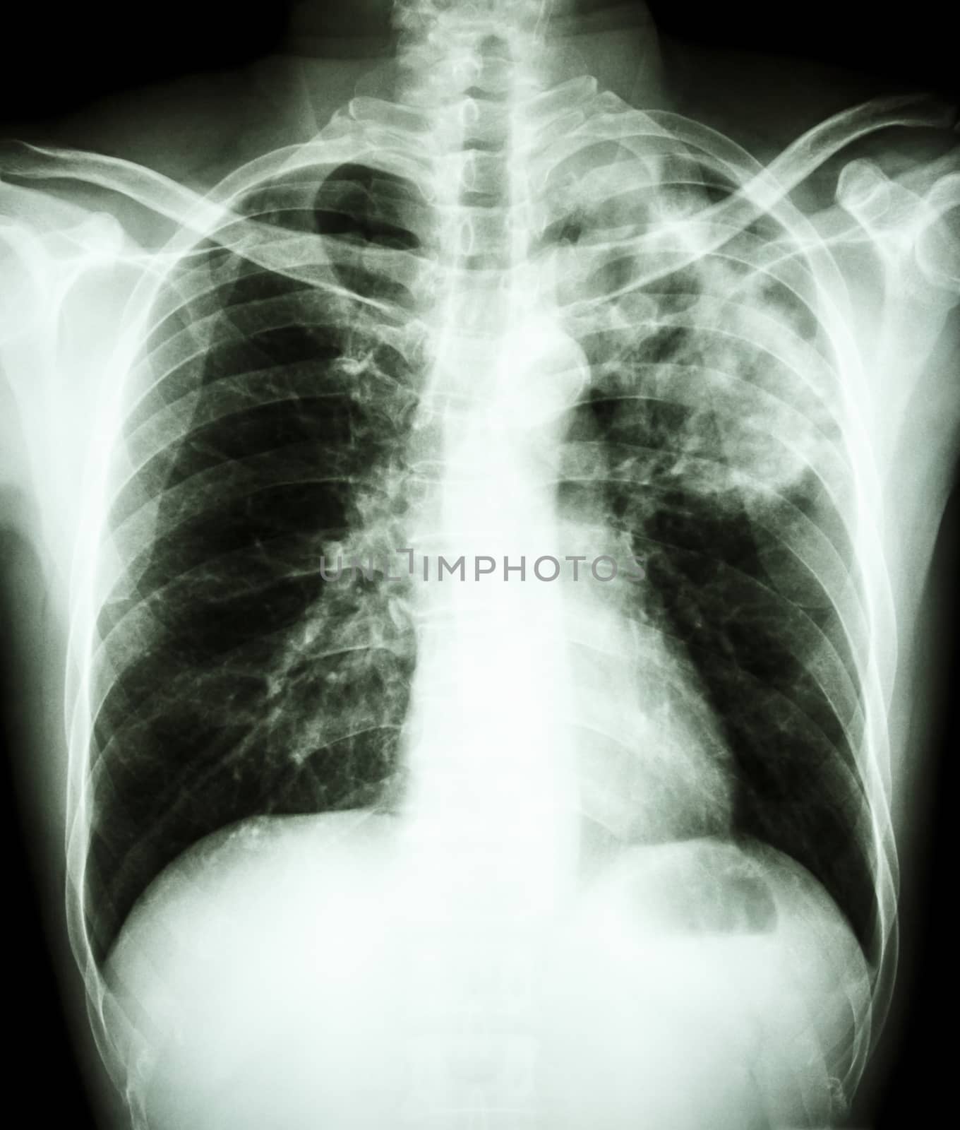 film chest x-ray show alveolar infiltrate at left upper lung due to Mycobacterium tuberculosis infection (Pulmonary Tuberculosis)