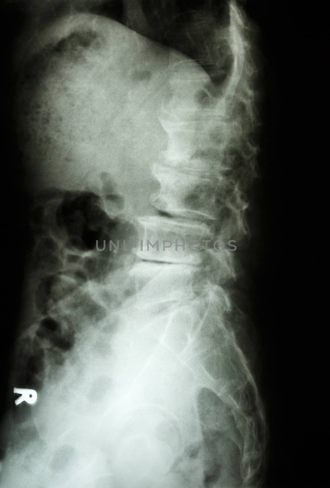 "Spondylolisthesis" film x-ray L-S spine lateral (lumbar-sacrum) of old aged patient