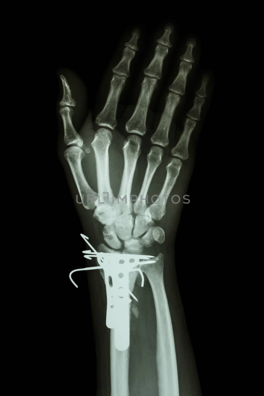 film x-ray wrist AP : show fracture distal radius (forearm's bone). It was operated and inserted plate and K-wire(Kirschner wire)