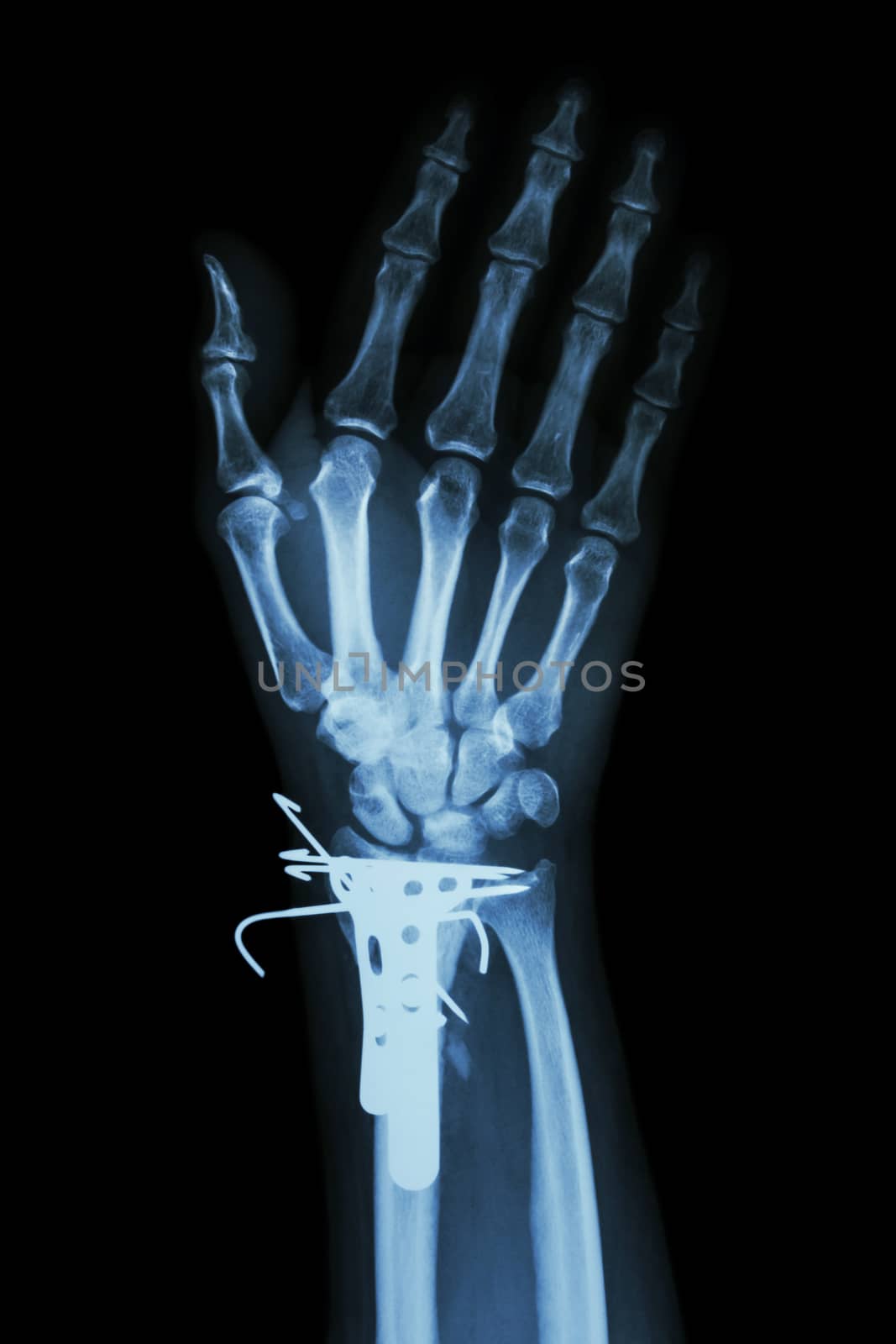 film x-ray wrist AP : show fracture distal radius (forearm's bone). It was operated and inserted plate and K-wire(Kirschner wire)