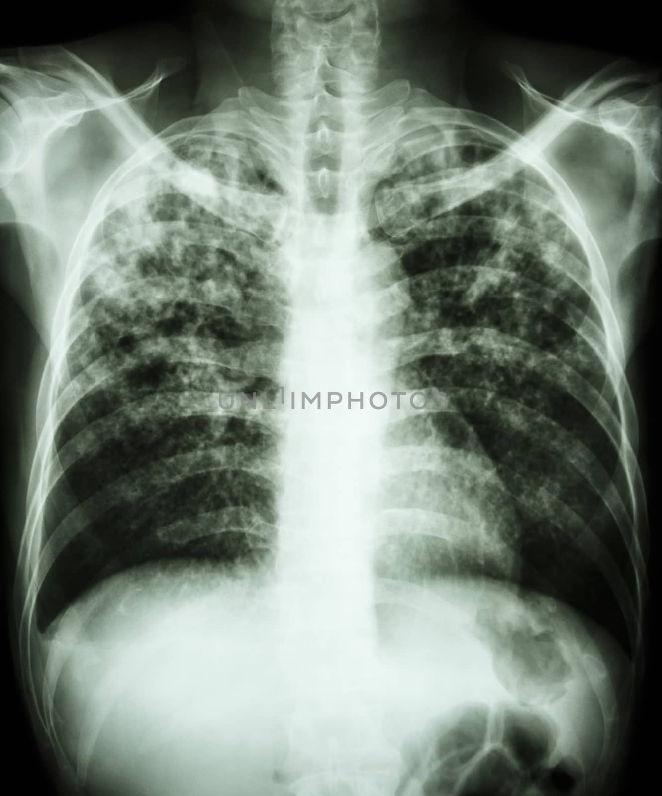 "Pulmonary tuberculosis" Film chest x-ray show interstitial infiltration both lung due to mycobacterium tuberculosis infection
