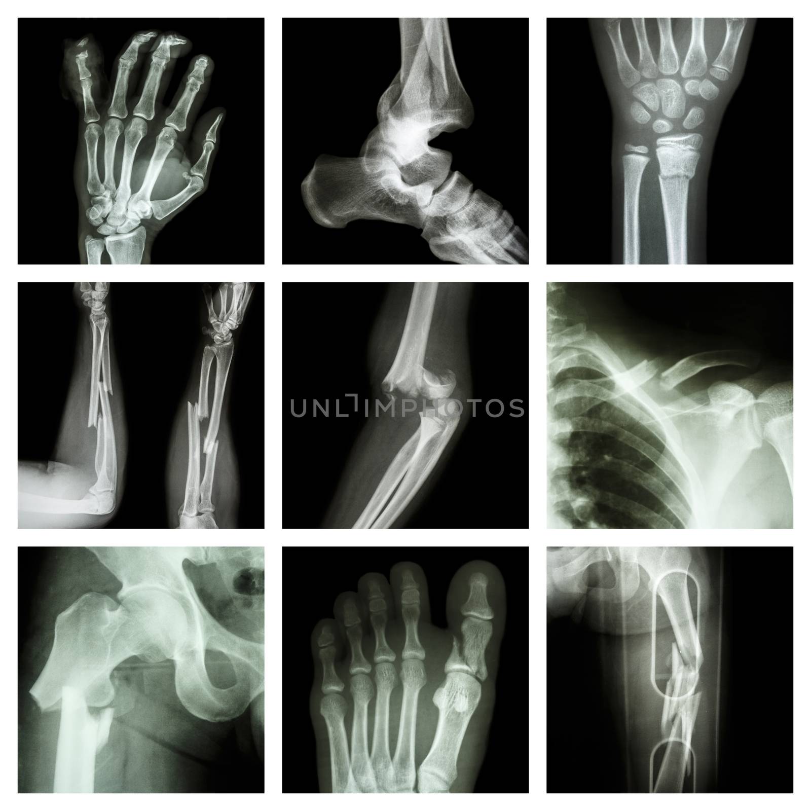 Collection of bone fracture