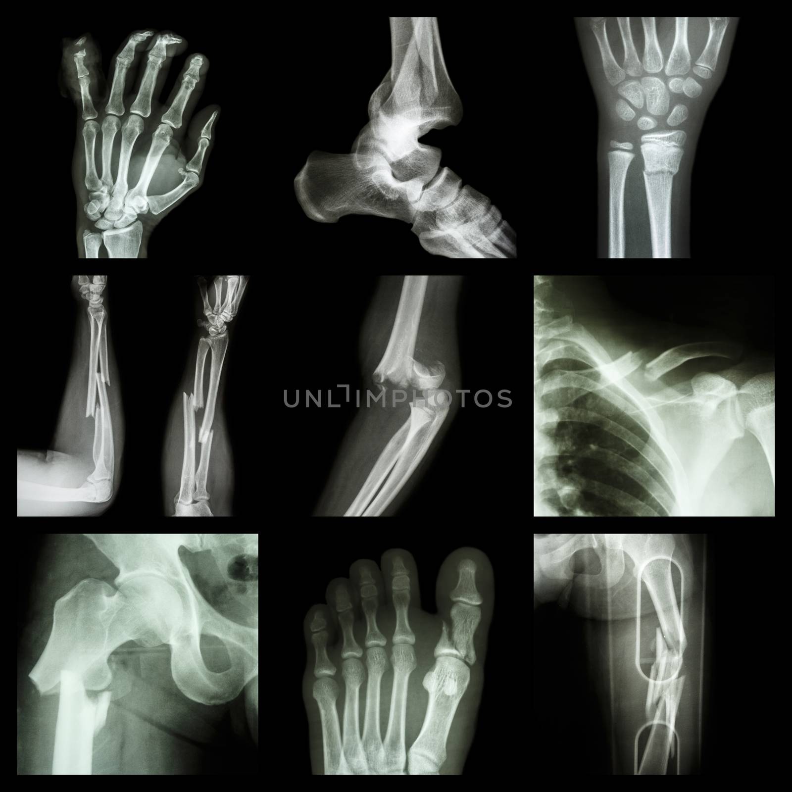 Collection of bone fracture