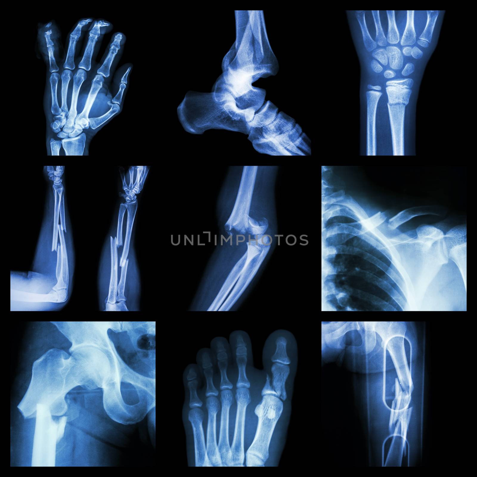 Collection of bone fracture by stockdevil