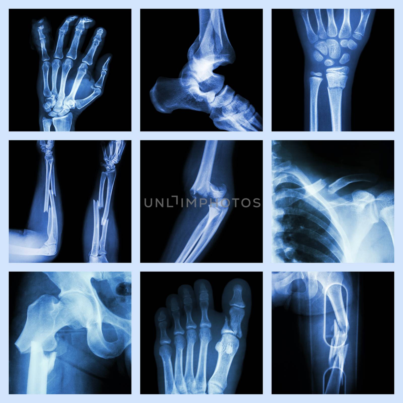 Collection of bone fracture