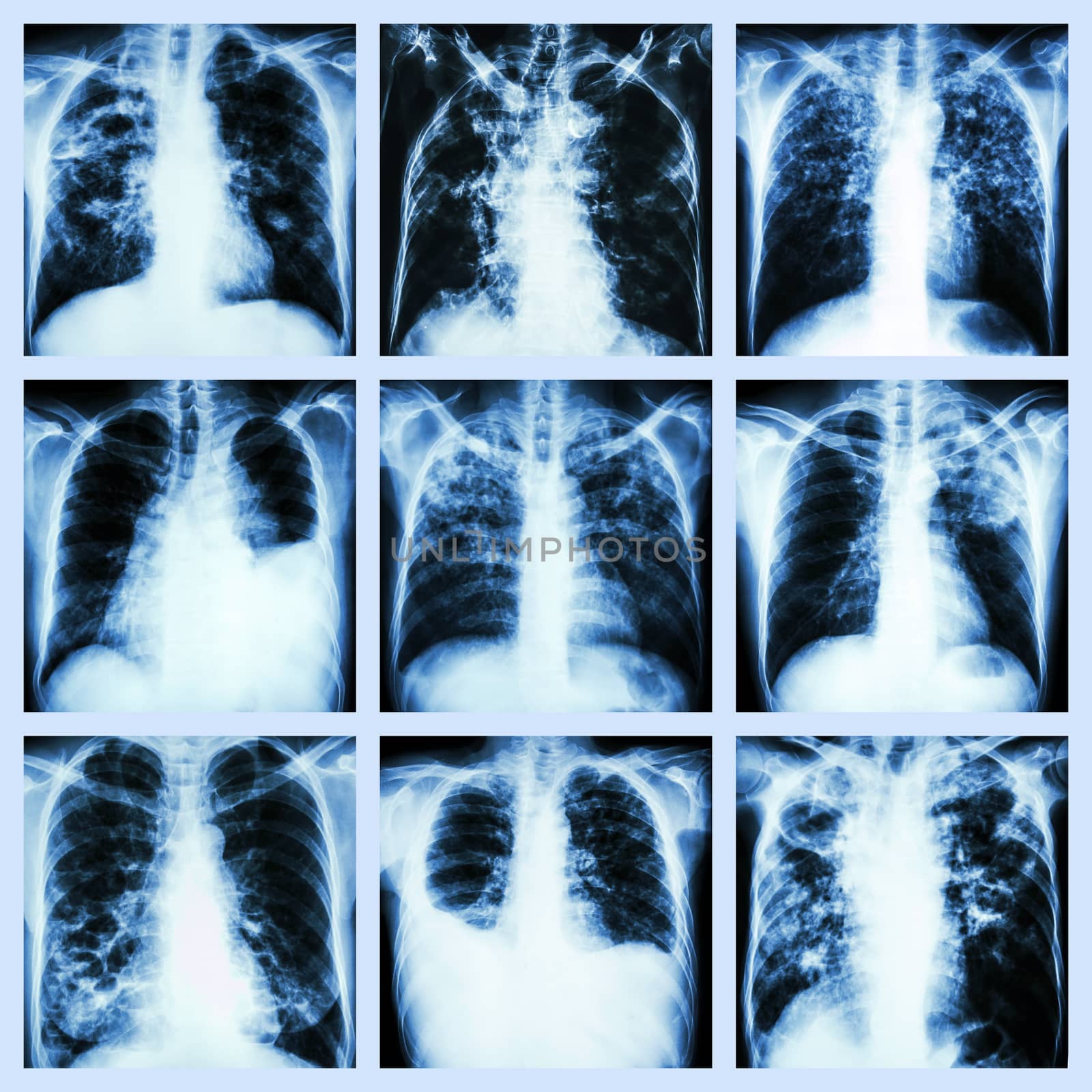 Collection of lung disease (Pulmonary tuberculosis,Pleural effusion,Bronchiectasis) by stockdevil