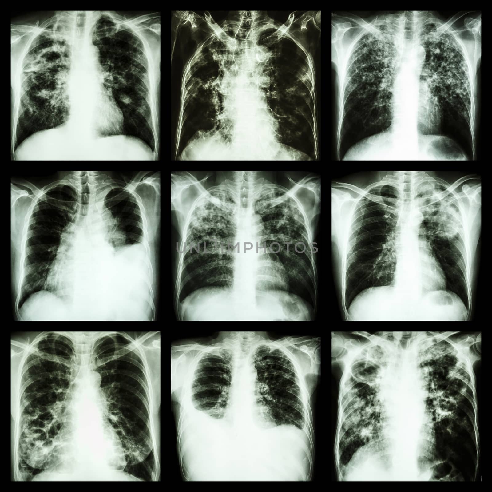 Collection of lung disease (Pulmonary tuberculosis,Pleural effusion,Bronchiectasis) by stockdevil