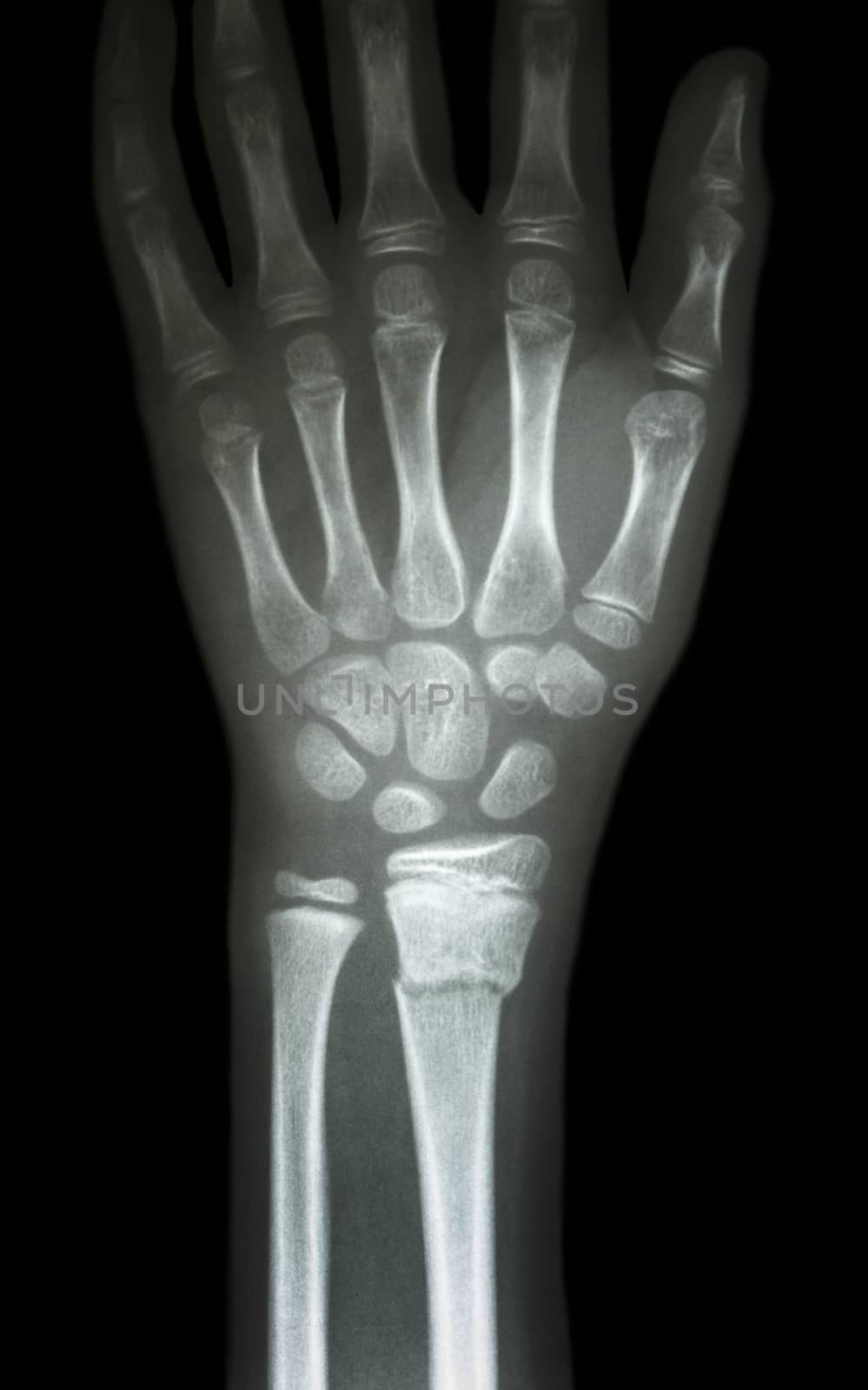 fiilm x-ray wrist show fracture distal radius (forearm's bone)