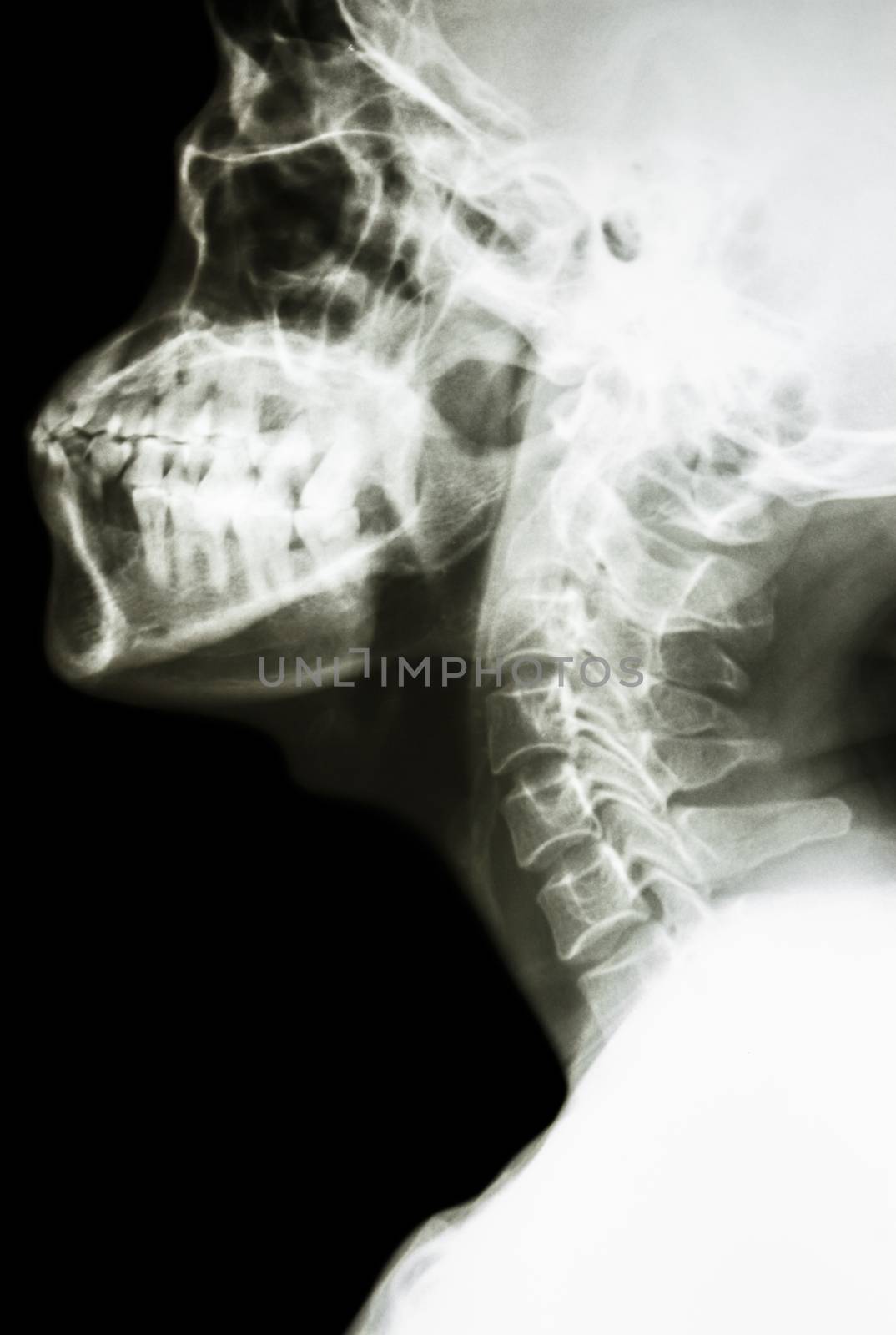 film x-ray cervical spine lateral : show normal thai man's cervical spine