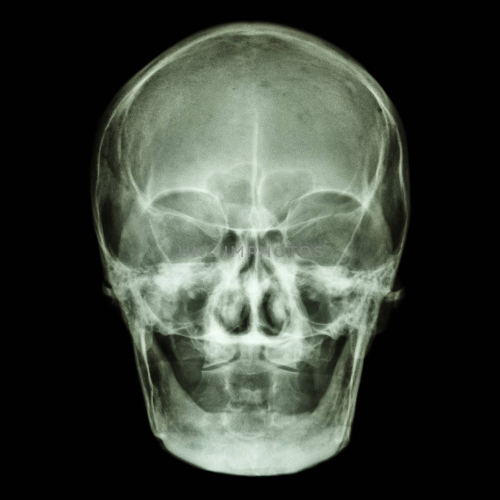 normal old aged asian skull (Thai people),(no tooth) by stockdevil