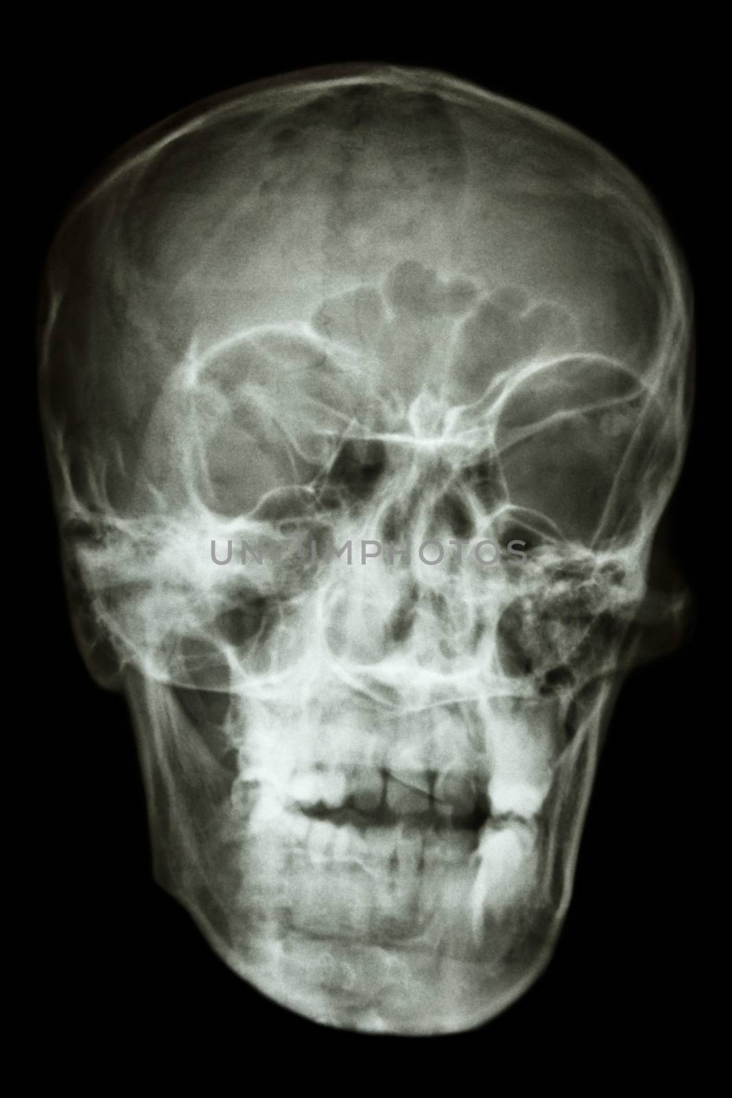 film x-ray asian people's skull (Thai people)