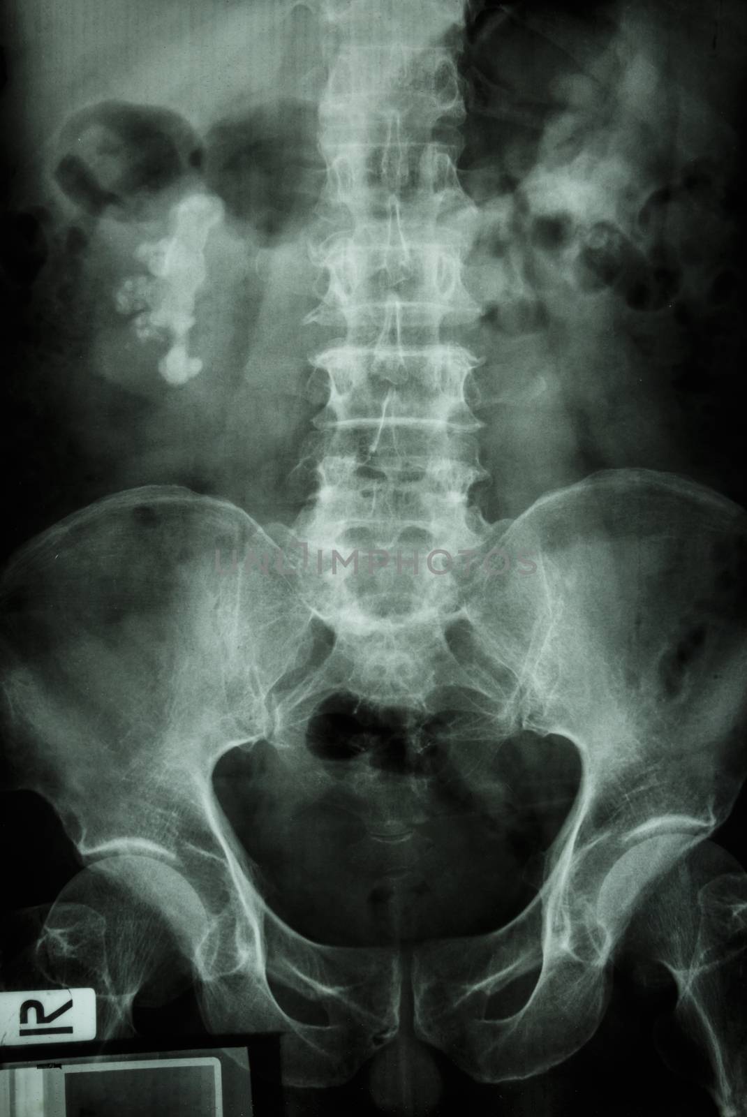 film x-ray show right renal calculi (staghorn)