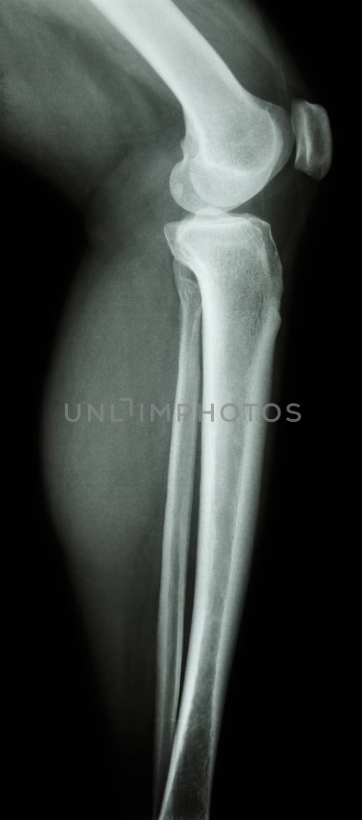 film x-ray knee lateral : normal human's knee&leg