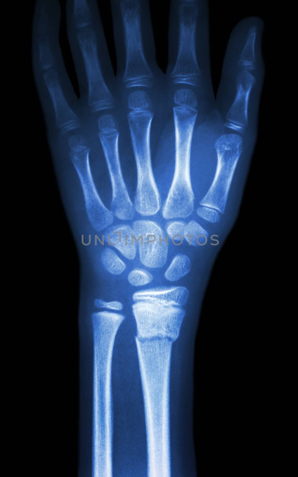 fiilm x-ray wrist show fracture distal radius (forearm's bone)