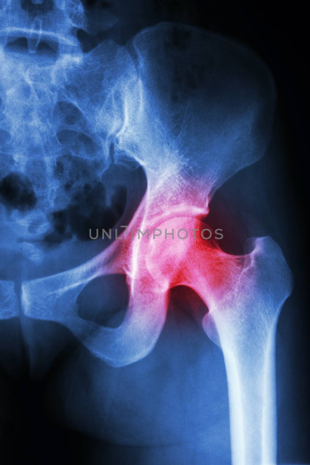 X-ray left hip and arthritis left hip