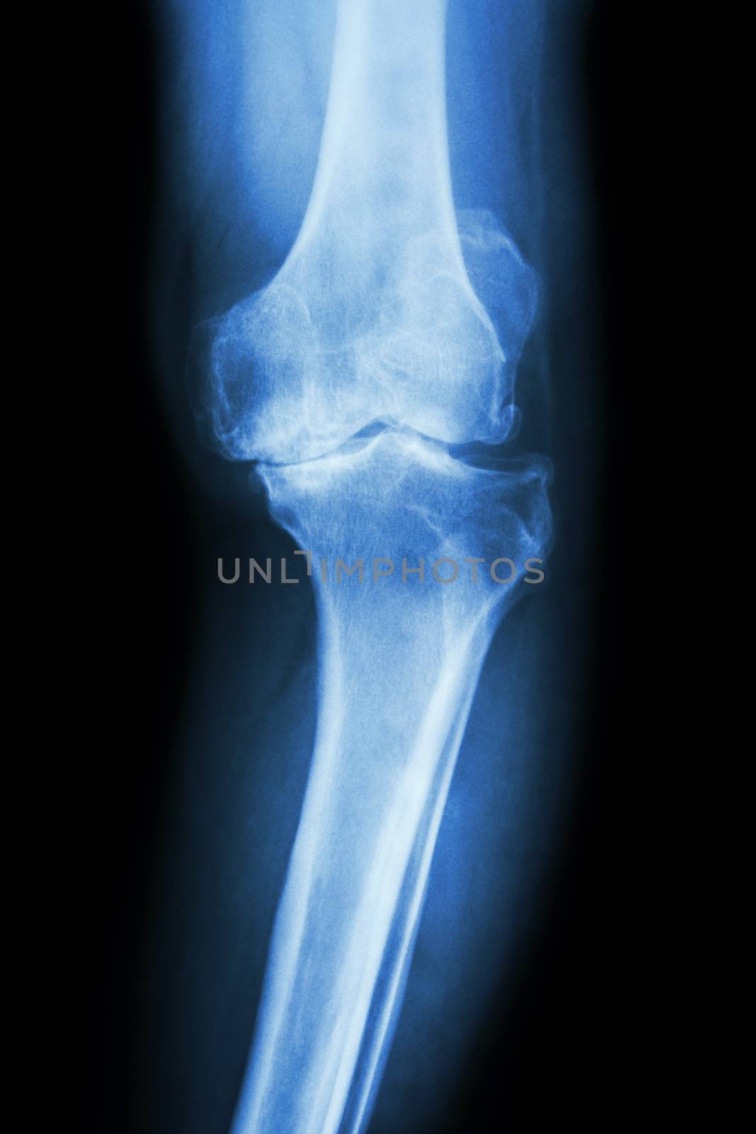 film x-ray knee AP of osteoarthritis knee patient (OA knee)