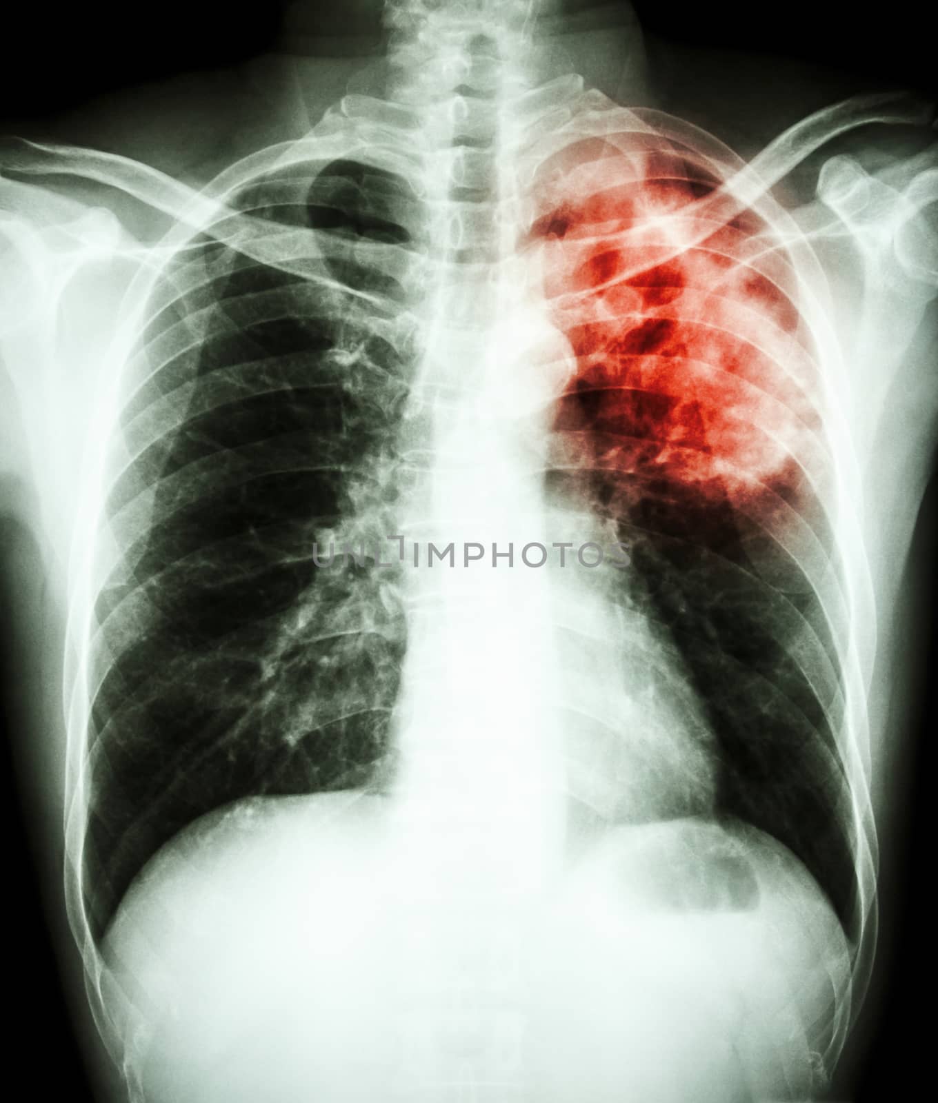 film chest x-ray show alveolar infiltrate at left upper lung due to Mycobacterium tuberculosis infection (Pulmonary Tuberculosis)