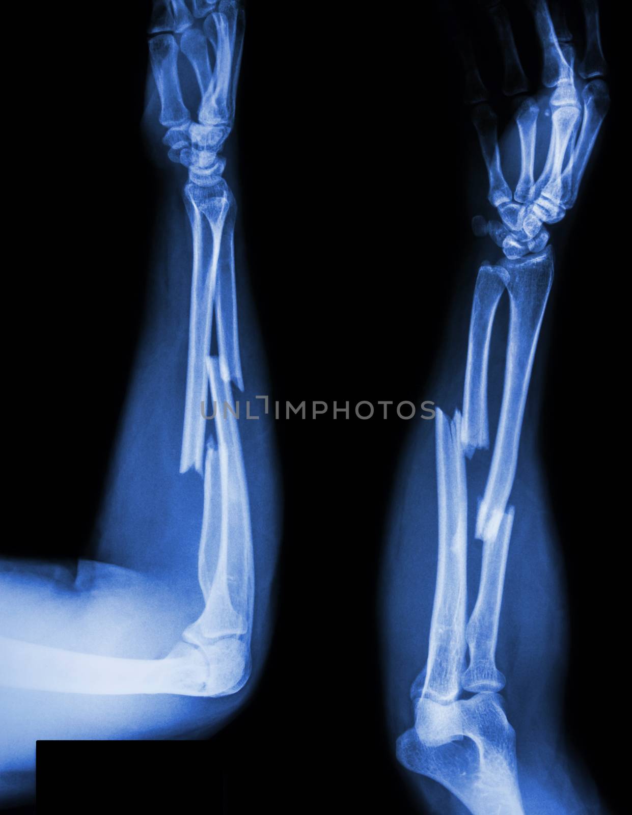 fracture shaft of radius & ulnar bone