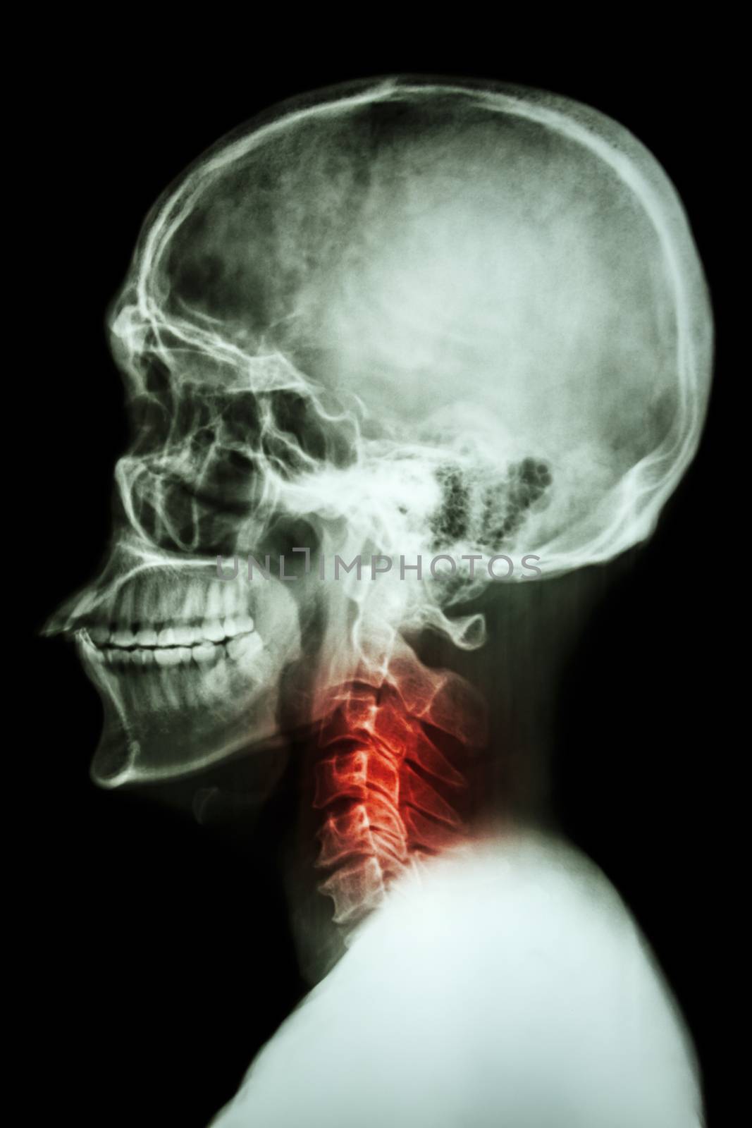 X-ray asian skull and cervical spine and neck pain