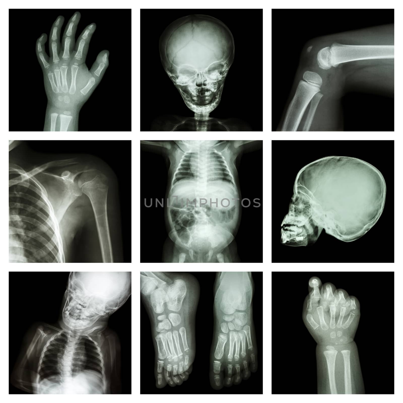 Collection x-ray part of child body by stockdevil