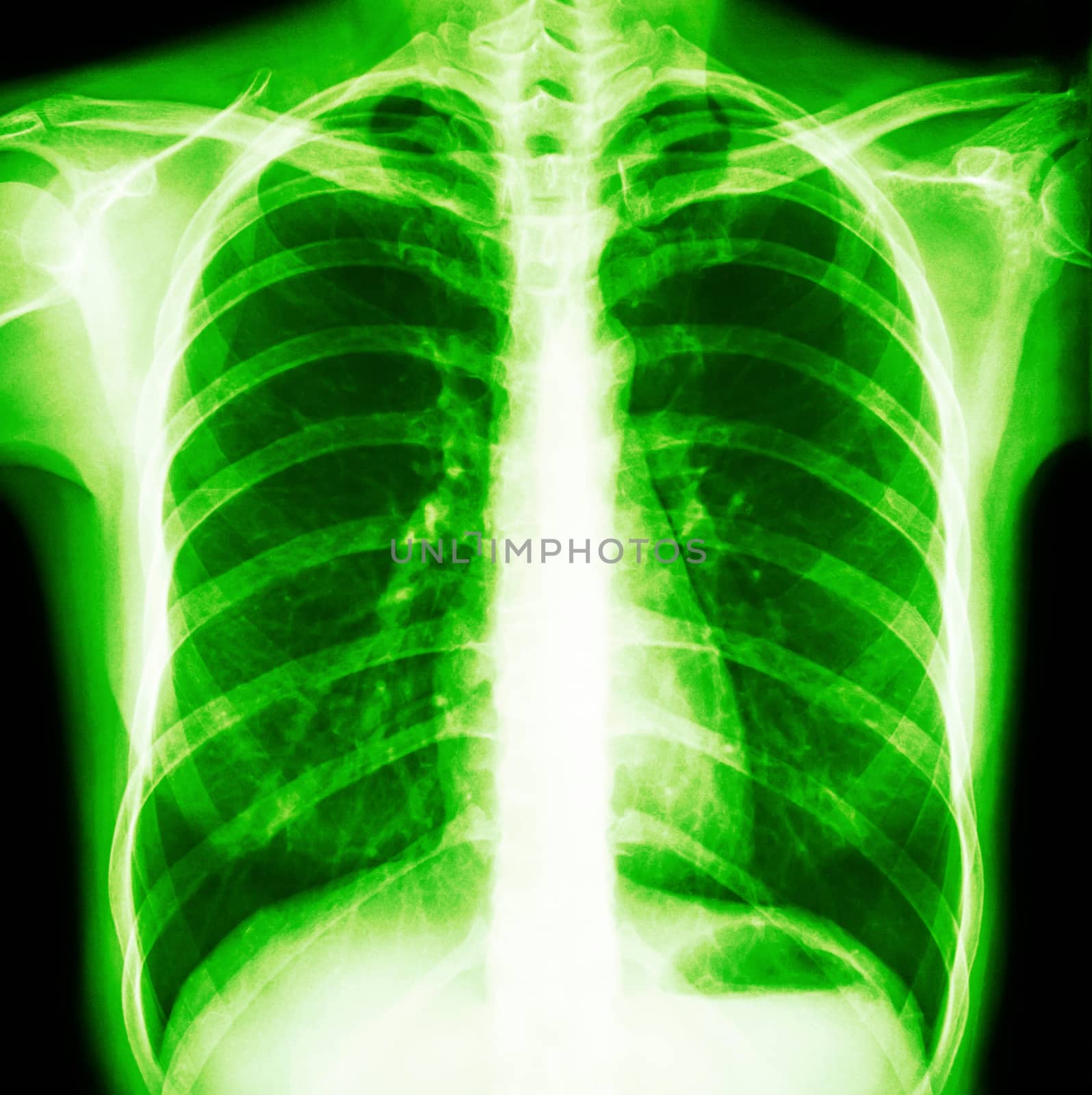 Film chest x-ray PA upright : show normal human's chest