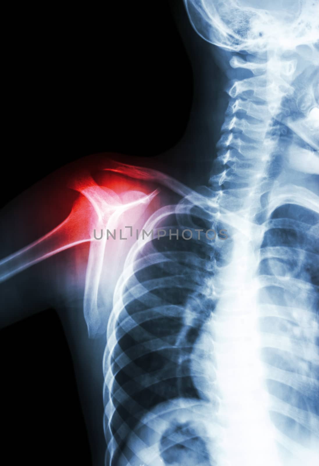 film x-ray transcapula Y view : show child's shoulder and arthritis at shoulder