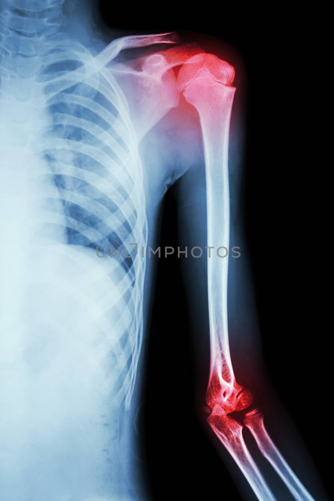 film x-ray left shoulder and arthritis at shoulder and elbow