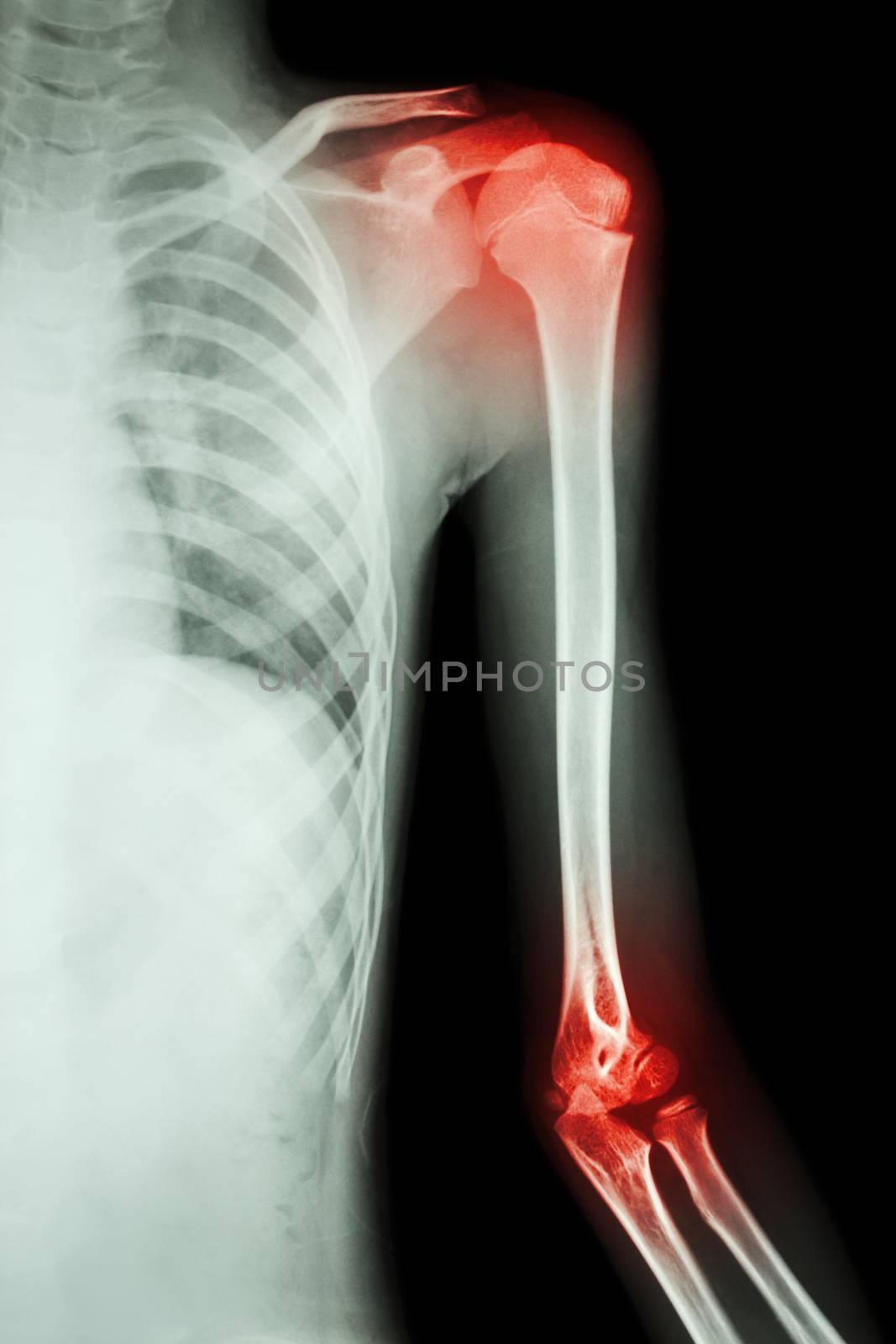 film x-ray left shoulder and arthritis at shoulder and elbow