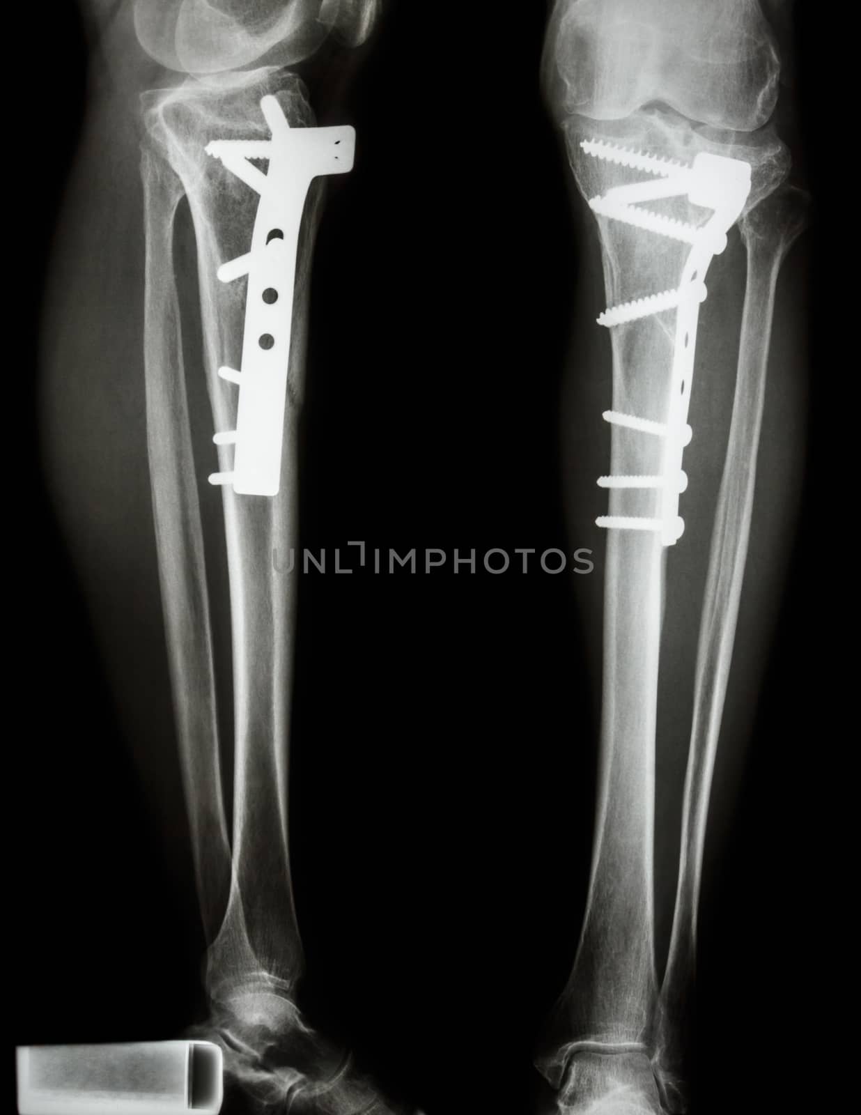 fracture tibia(leg bone). It was operated and internal fixed by plate&screw